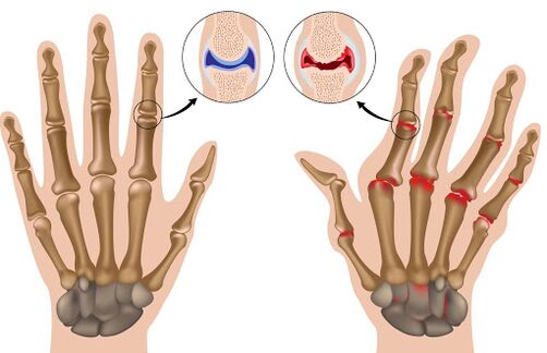 Arthritis and its manifestations