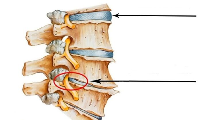 spinal cord injury in the event of cervical osteochondrosis