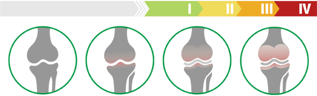 Clinical stage of knee joint arthrosis (stage of knee joint arthrosis)