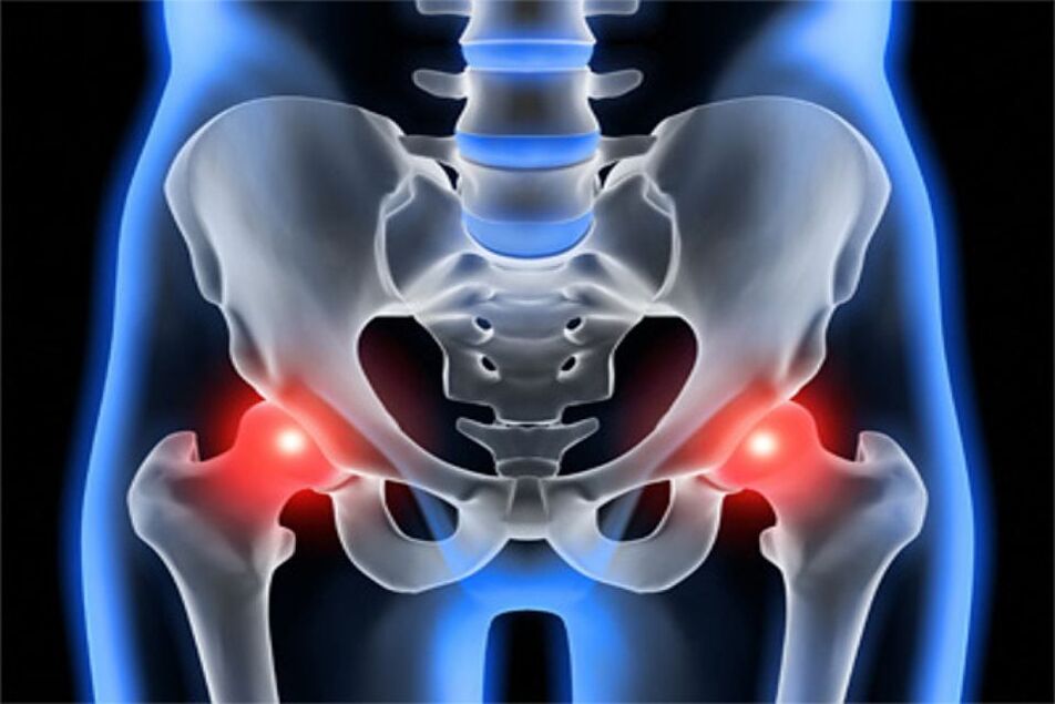 Forming arthrosis of the hip joint (coxarthrosis)