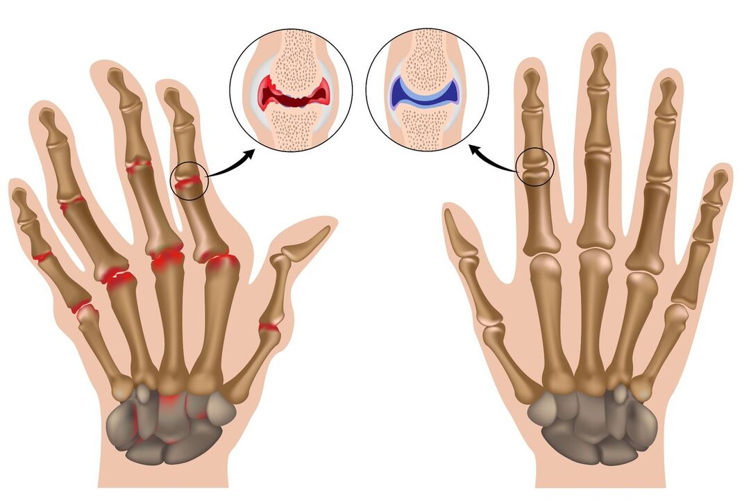 Healthy hand joints and affected polyarthritis