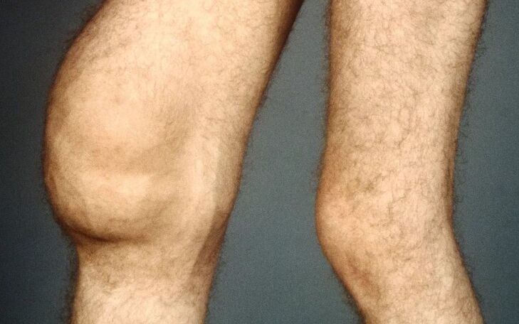 Post -traumatic arthrosis from the knee joint