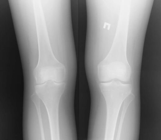 Radiography of the knee joint