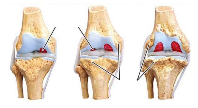 Complications of joint arthrosis