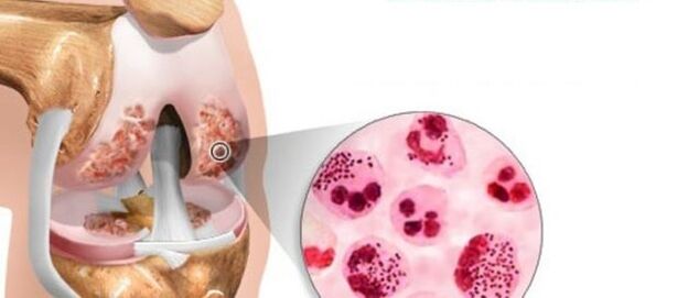 that leads to the development of arthrosis