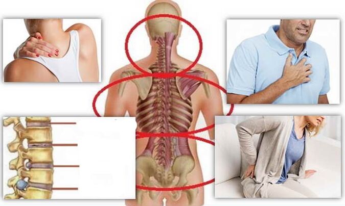 A place of illness for osteochondrosis