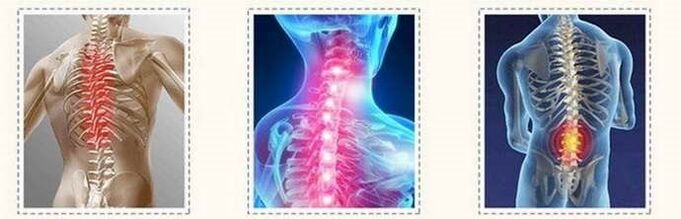 Spinal cord osteochondrosis