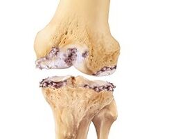 damage to the knee joint due to arthrosis